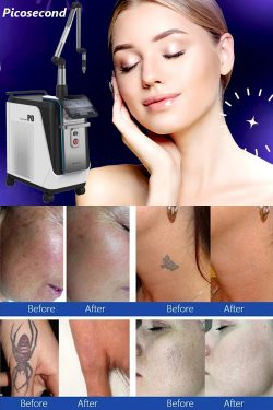 What to do After Picosecond Laser Treatment? 5 Amazing Skincare Tips
