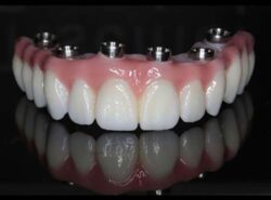 What to Expect During Full Mouth Dental Implants Near Me Procedure