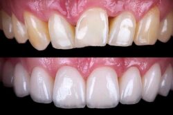 What to Expect from Laser Gum Depigmentation Near Me