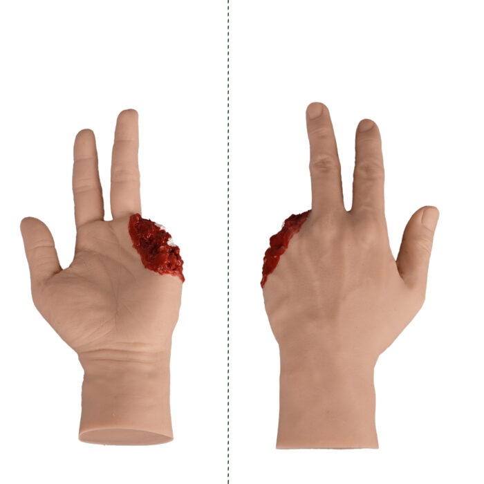 Trauma Hand with Amputation Finger