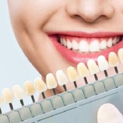Explore Composite Veneers: A Popular Choice in Dubai Dentistry