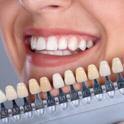 Fast and Affordable Smile Upgrades with Composite Veneers in Dubai