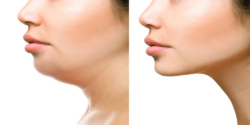 Get a More Sculpted Neck and Jawline with Double Chin Liposuction