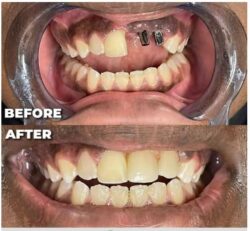 Restore Your Smile with Dental Implants at The Smile Mission