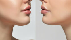 Can Double Chin Liposuction Help You Look Younger?