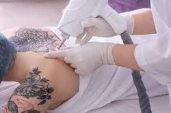 Essential Insights into Picosure Tattoo Removal in Dubai