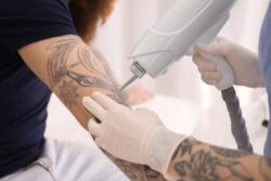 Discovering the Effectiveness of PicoSure for Tattoo Removal