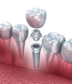 The Case for Single Tooth Implants: Benefits Over Dental Bridges