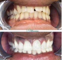 Restore Your Smile with Dental Implants