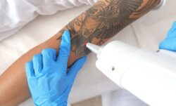 How Safe Is Laser Tattoo Removal in Dubai? Expert Insights