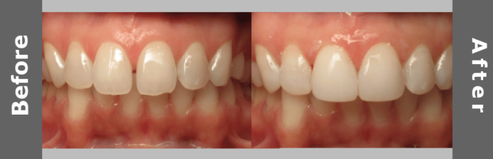 Tooth Cleaning, Laminates And Veneers Images