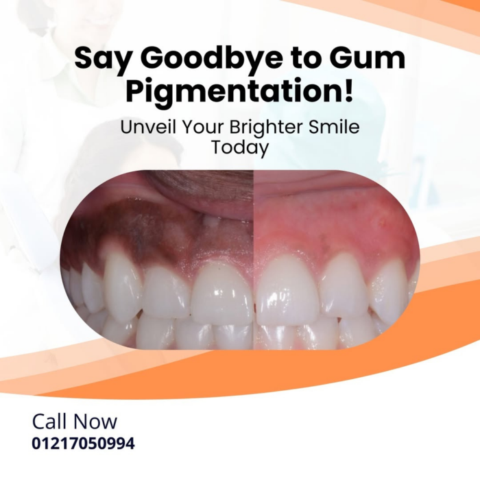 Say Goodbye to Gum Pigmentation