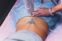 Say Goodbye to Tattoos in Just a Few Sessions with Laser Tattoo Removal!