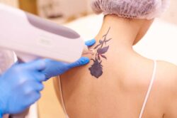 Adventure Begins When Regret Ends – Get Laser Tattoo Removal Today!