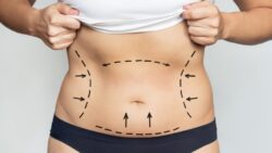 How to Set Realistic Expectations for Laser Liposuction in Dubai