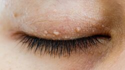 How to Safely Remove Skin Tags on Your Eyelids