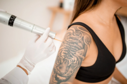 Transform Your Skin with Fast, Effective Laser Tattoo Removal!