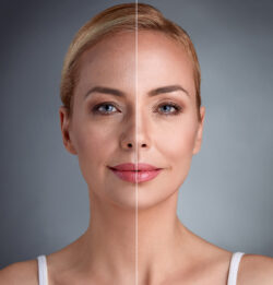 Endolift: From Consultation to Glow