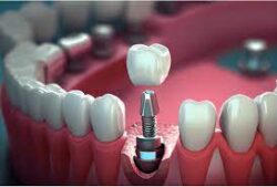 Dental Implants Uncovered: A Simple Explanation of the Treatment