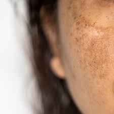 Melasma Treatment: Finding the Best Options for Your Skin