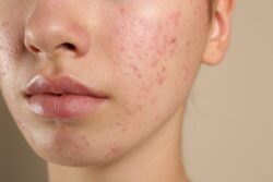 Acne Management from Morning to Night in Dubai