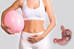 Is Gastric Balloon Placement Effective?