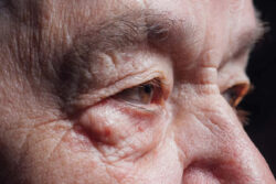 Swollen Eyelid Treatment in Cape Town – Restore Comfort and Clarity