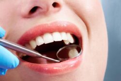 Tooth Filling Cost: What to Expect