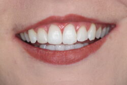 Teeth Whitening Tips to Avoid Tooth Damage