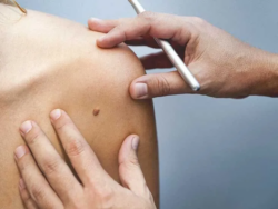Quick and Easy Skin Tag Removal for Perfectly Smooth Skin