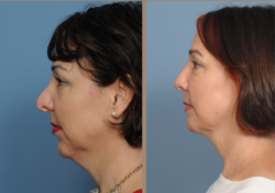Considering Chin Implant Surgery – Seeking Advice and Experiences