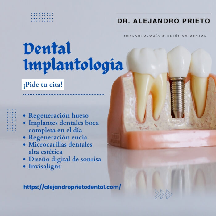 Implantes Cigomáticos