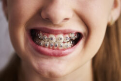 Straighten Your Smile with Dental Braces in Saskatoon
