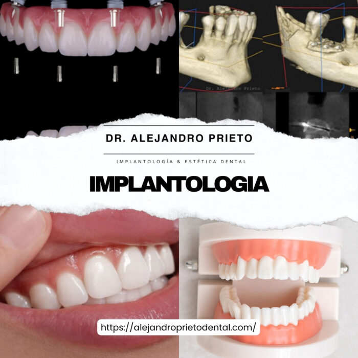Blanqueamiento Dental