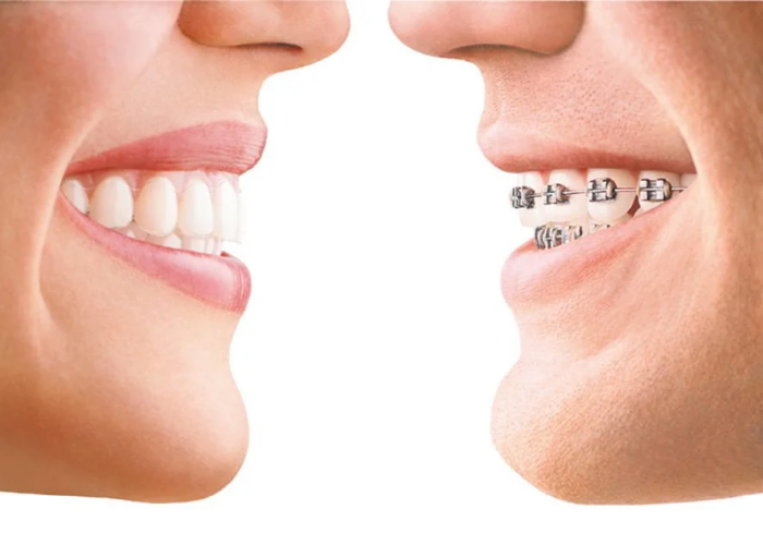 Custom Dental Implants and Dentures for Missing Teeth Solutions