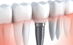 Best Dental Clinic in India for Dental Implants