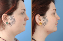 Sculpt Your Look with Face Liposuction