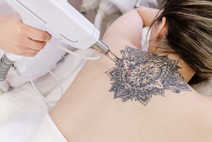 Tattoo Removal in Gurgaon