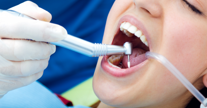 Broken Teeth Fillings