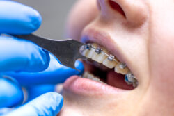 Top-Rated Orthodontist in Lorton, VA: Expert Care for a Confident Smile