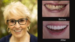 Overdentures Arlington Options With Functional Design Principles