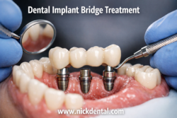 Dental Implant Bridge Treatment | Nikahd Dental