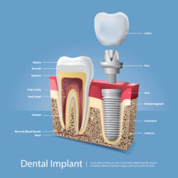 Dental implant bridge | UrgentDent