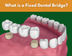 Restore Your Smile with a Fixed Dental Bridge