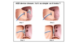 Device Closure Surgery of ASD VSD PDA in Jaipur