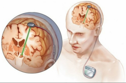 Deep Brain Stimulation Surgery Cost in India – Hospisity