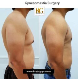 Gynecomastia Before and After: What Results Really Look Like
