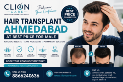 best hair transplant in gujarat in ahmedabad