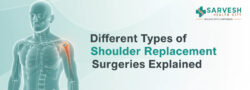 Different Types Of Shoulder Replacement Surgeries Explained