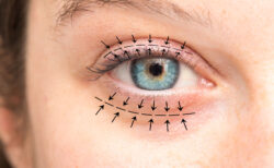 Blepharoplasty Surgery Cape Town for Youthful, Refreshed Eyes